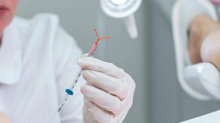Veja como Conseguir Colocar o DIU de Forma Gratuita